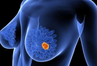 Câncer de mama: cinco fatos que todos devemos saber