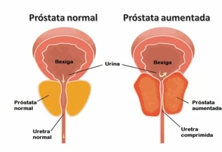 Câncer de próstata: Teste identifica o risco de desenvolvimento da doença