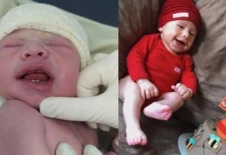 Bebê que nasceu com dentes está com três meses; dentes de leite já estão apontando
