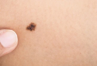 Diagnósticos de melanoma caem mais de 20% no último ano, aponta estudo