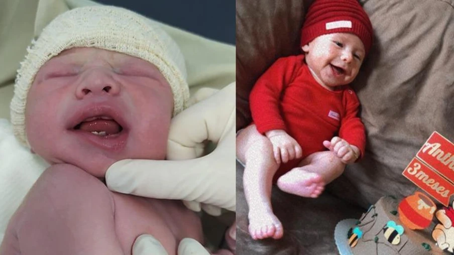 Bebê que nasceu com dentes está com três meses; dentes de leite já estão apontando