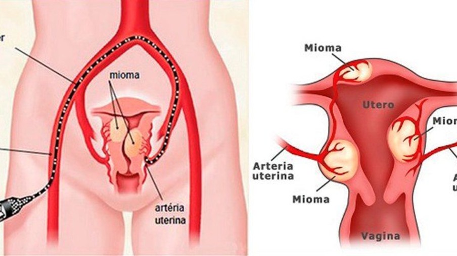 2 milhões de brasileiras têm miomas uterinos