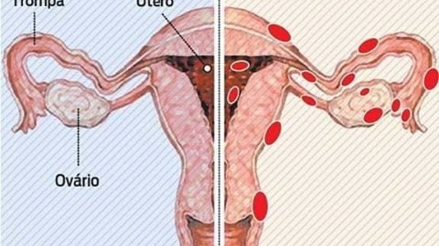 Dores e excesso de sangramento menstrual podem ser endometriose