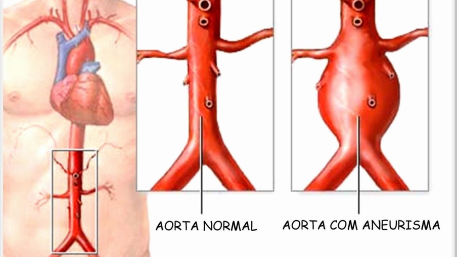 Aneurisma da Aorta: riscos aumentados