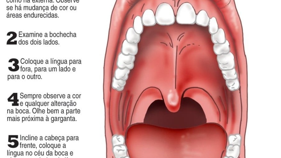 Câncer de garganta: aprenda a identificar os sintomas