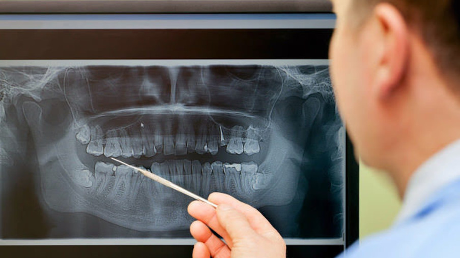 Osteoporose cresce e põe em risco a saúde dos dentes