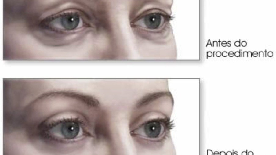 Cirurgia nas pálpebras pode causar alterações na anatomia dos olhos