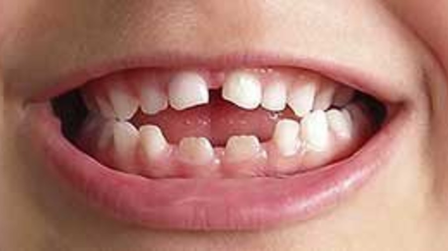 Dentes afastados ou mordida desigual? Pode ser maloclusão