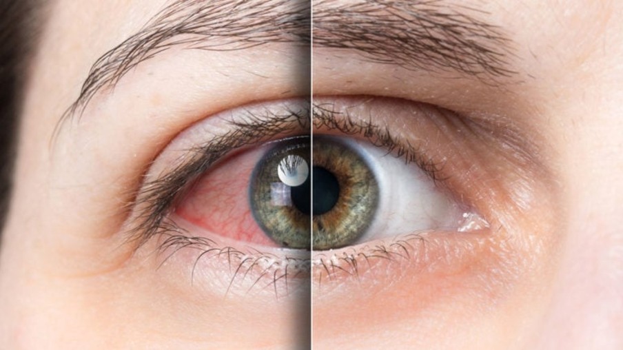 Doença de olho seco e  diabetes: estudo revela necessidade de triagem