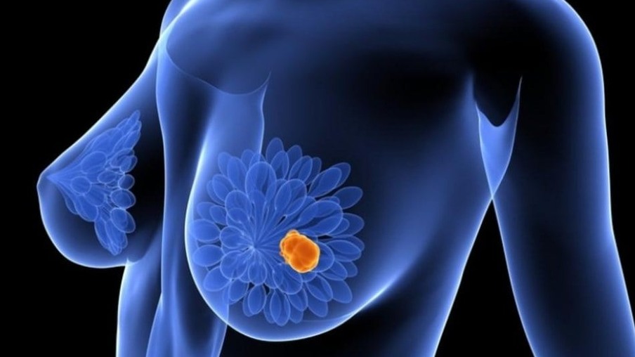 Câncer de mama: cinco fatos que todos devemos saber
