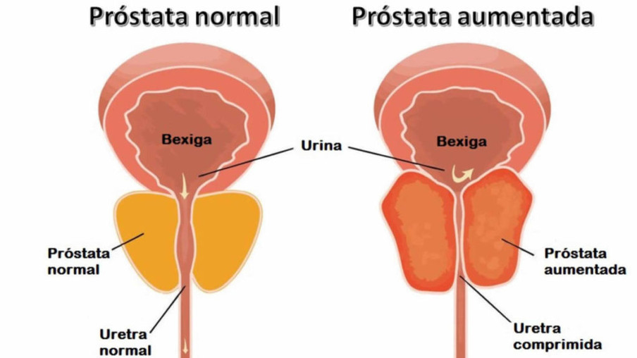 Câncer de próstata: Teste identifica o risco de desenvolvimento da doença
