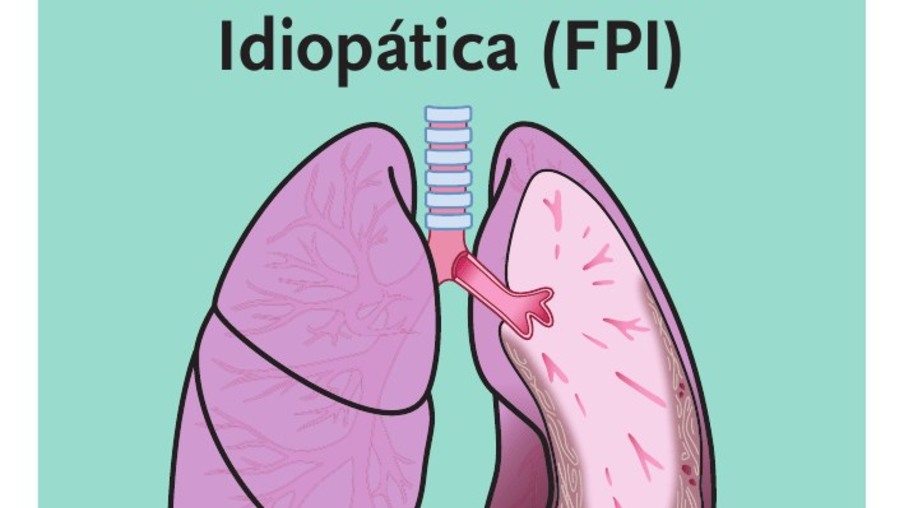 Fibrose pulmonar idiopática atinge principalmente idosos