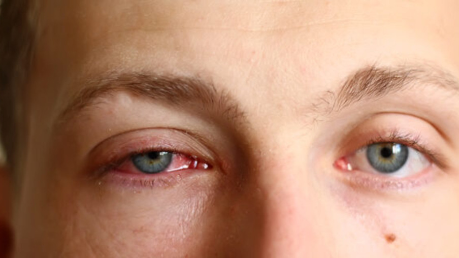 Verão aumenta a síndrome do olho vermelho; veja por quê
