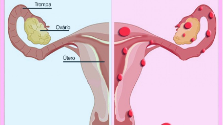 Mitos e Verdades da endometriose