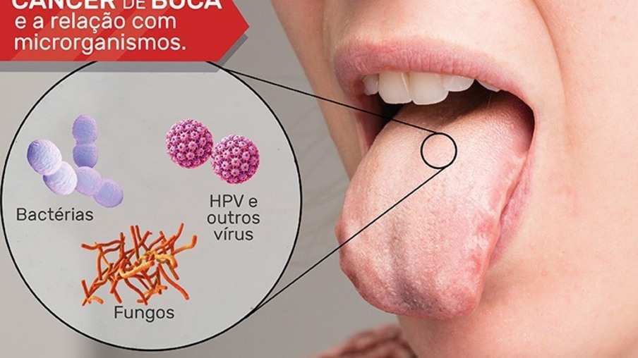 Câncer de boca atinge 14 mil ao ano no Brasil
