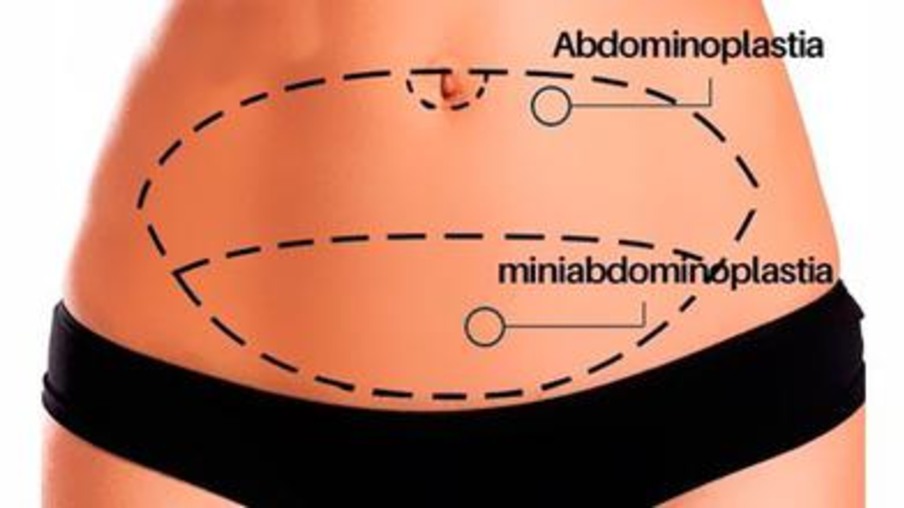 Miniabdominoplastia é eficiente em minimizar alterações inestéticas