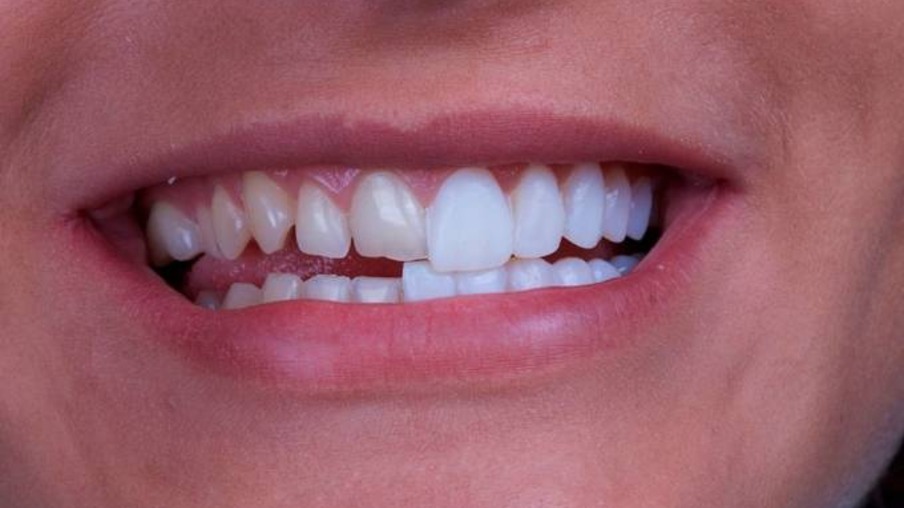 Dentes desalinhados prejudicam fala, mastigação e até autoestima