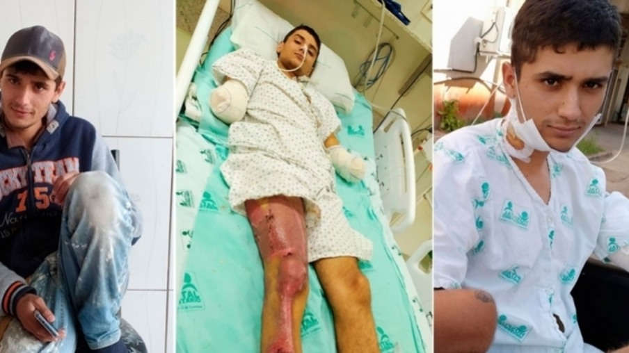 Ramilândia: Jovem que sofreu descarga elétrica e teve braços amputados precisa de ajuda para comprar próteses