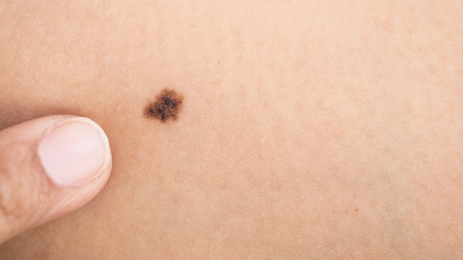 Diagnósticos de melanoma caem mais de 20% no último ano, aponta estudo