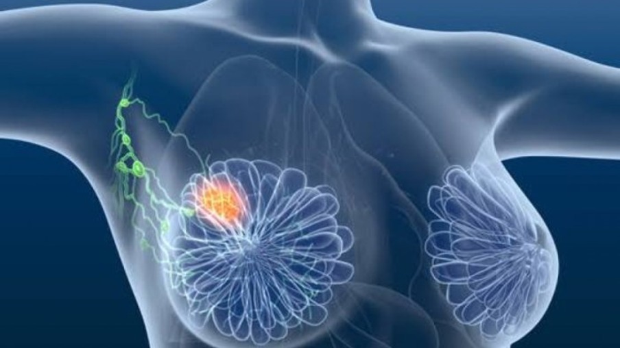 Unioeste mapeia relação de câncer de mama com agrotóxico 