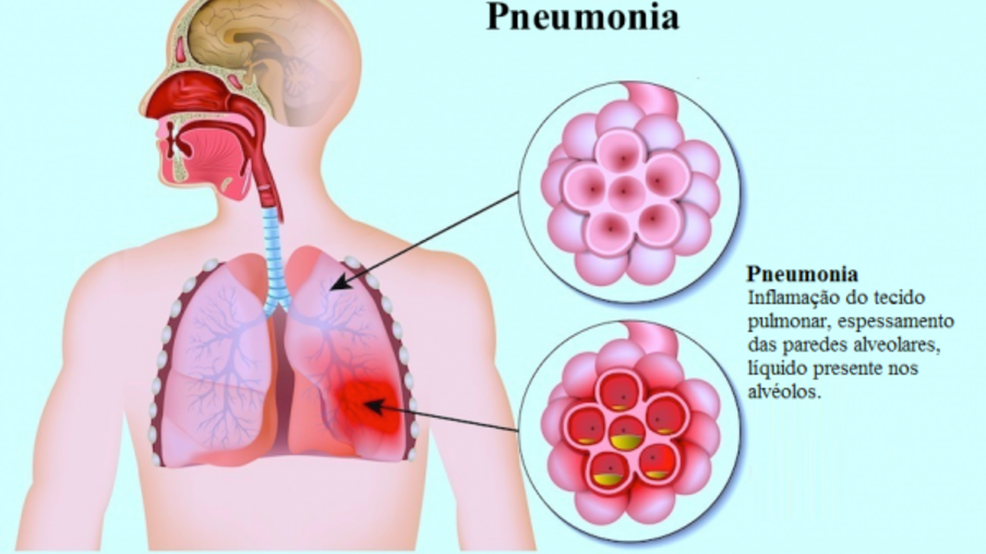 A importância da vacinação contra doenças pneumocócicas em crianças e idosos